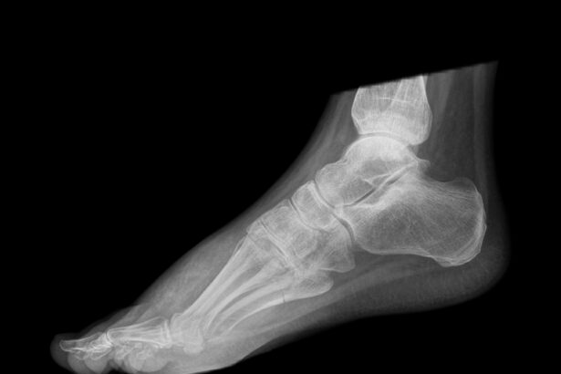 Bone density