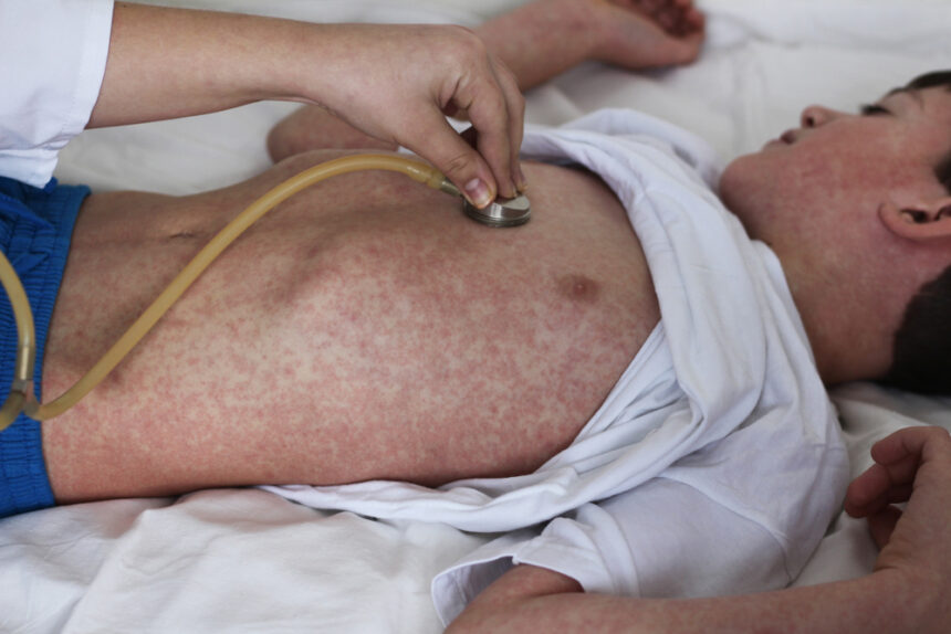 Pennsylvania measles outbreak